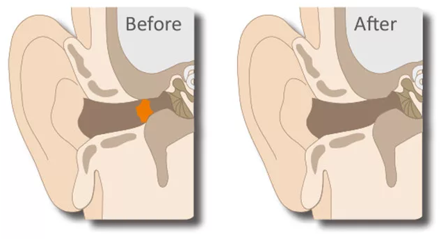 ear wax removal - before and after